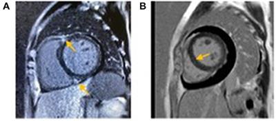 Clinical Characteristics of Cryoglobulinemia With Cardiac Involvement in a Single Center